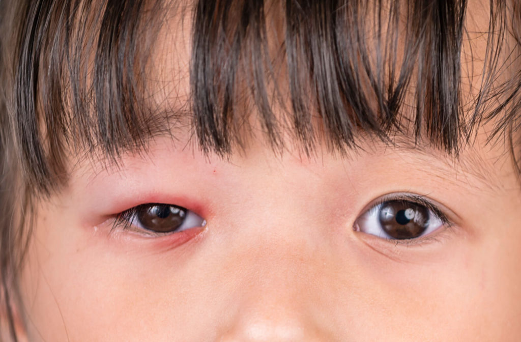 Close-up of a child's eyes. The right eyelid is red and inflamed.